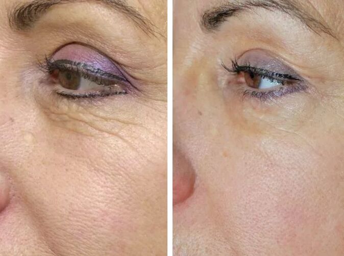 Laser de câmp înainte și după